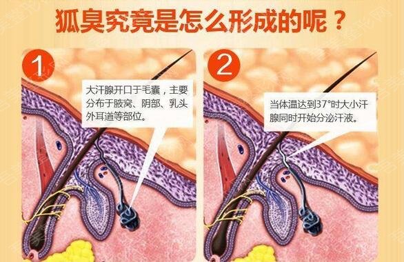 南海人民医院美容中心狐臭调节