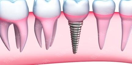牙齿种植