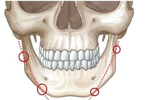 下颌角磨骨