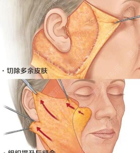 拉皮术后10天