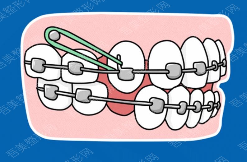 牙齿矫正.