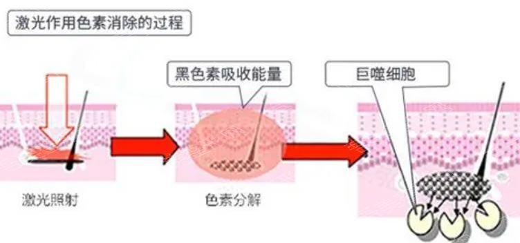 激光嫩肤