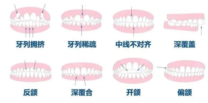 牙齿矫正