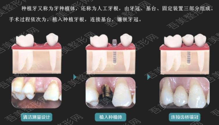 牙齿种植hg11.jpg