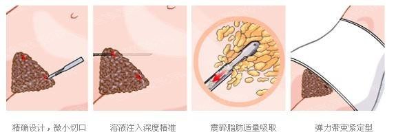 桂林华美整形医院科普腰腹吸脂手术