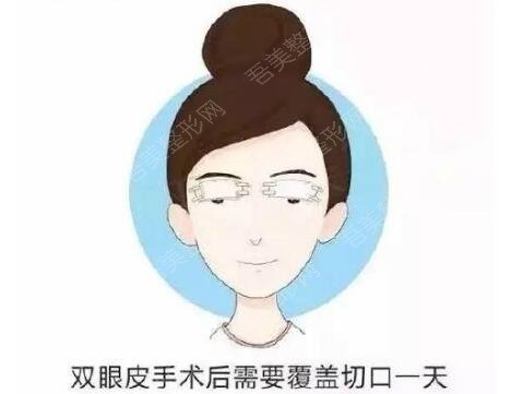 上海九院双眼皮手术科普