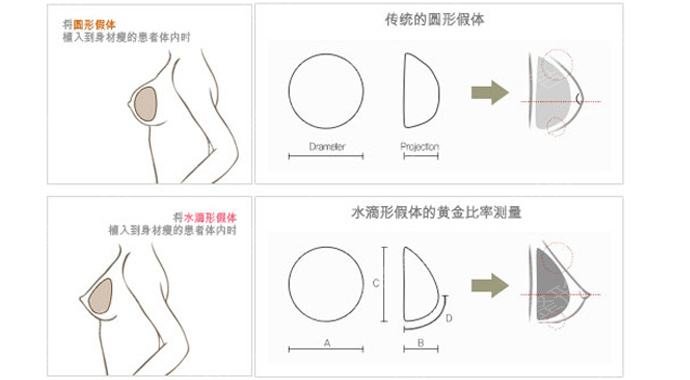 北京八大处整容医院科普隆胸手术