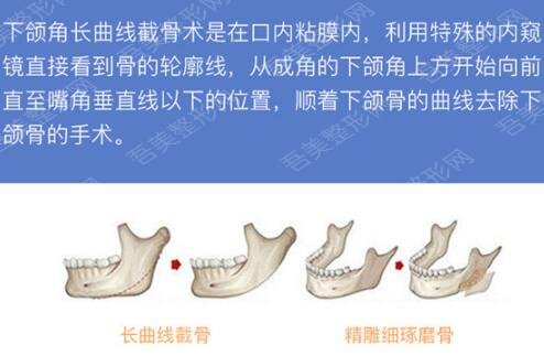 上海九院下颌角磨骨手术科普