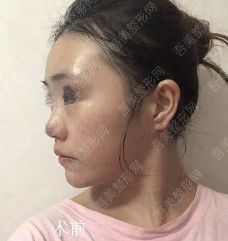 深圳江南春天医疗美容隆鼻案例分享