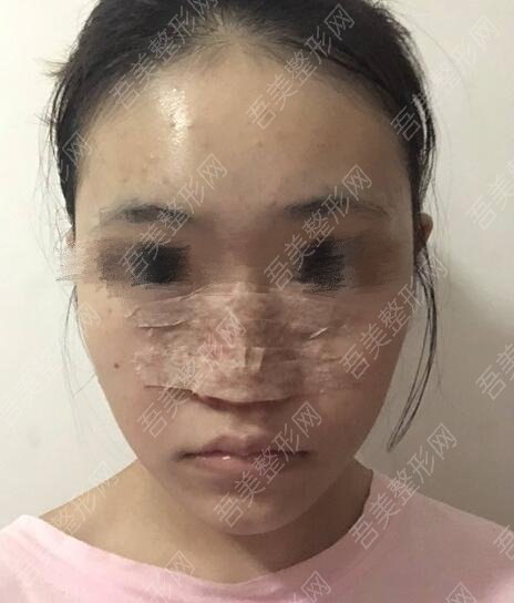 深圳江南春天医疗美容隆鼻案例分享