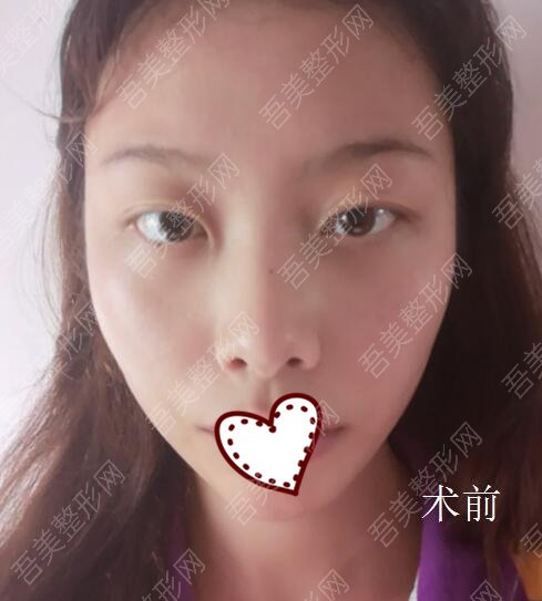 深圳星妍医疗美容隆鼻案例分享