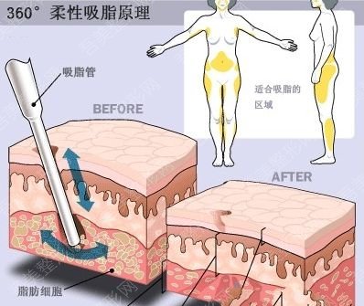 韩岩医生科普吸脂手术