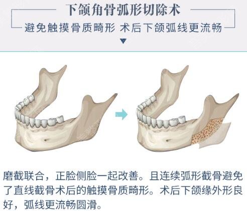 席静医生科普下颌角整形