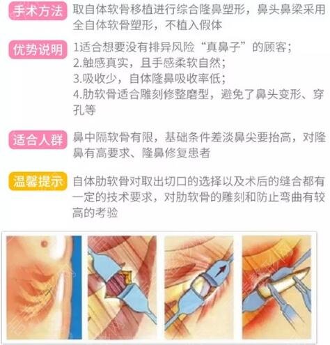 蒋亚楠医生科普肋骨隆鼻手术