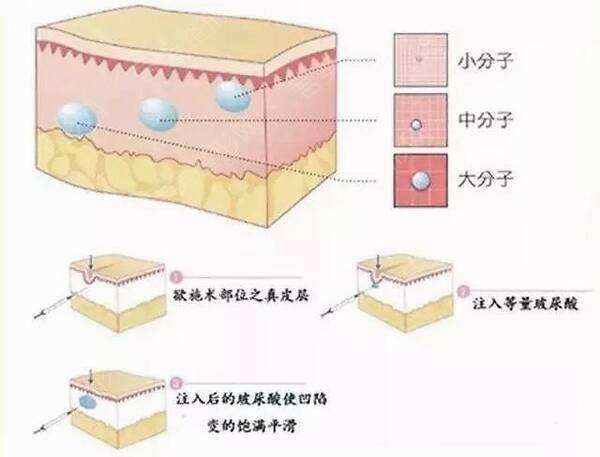 玻尿酸隆鼻后轻微撞到鼻子会歪吗