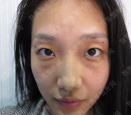 北京祛眼袋手术日记