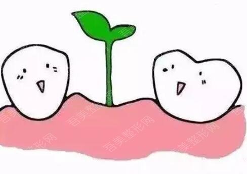 牙齿种植