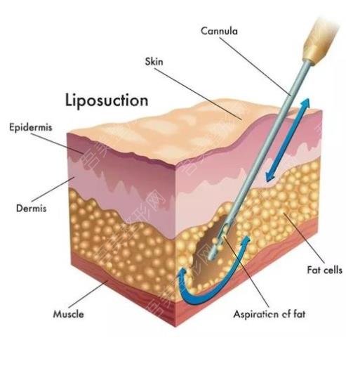吸脂减肥